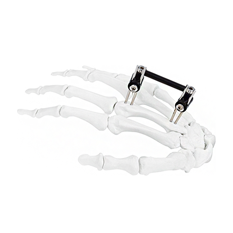 Cn Manufacturer Finger External Fixator for Mini Fixator Straight Type