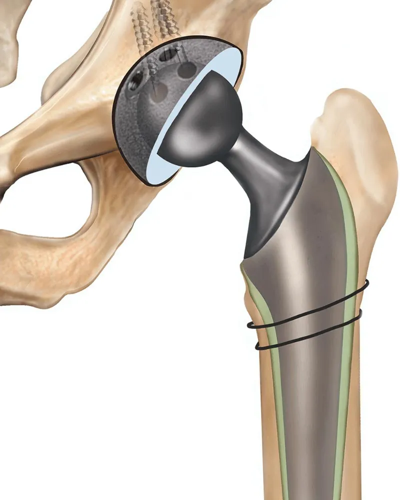 Knee Implant Casting 2