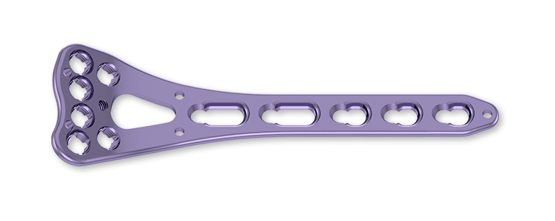 Orthopedic Locking Plate for Distal Radius