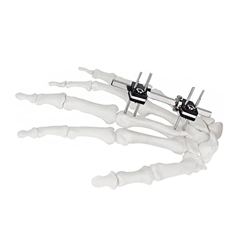 Cn Manufacturer Finger External Fixator for Mini Fixator Straight Type