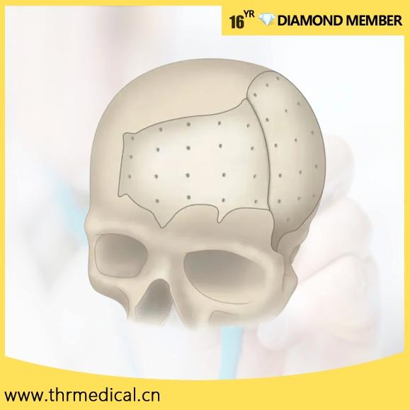 Custom Patient Specific Implant Maxillofacial Repair and Fixation System