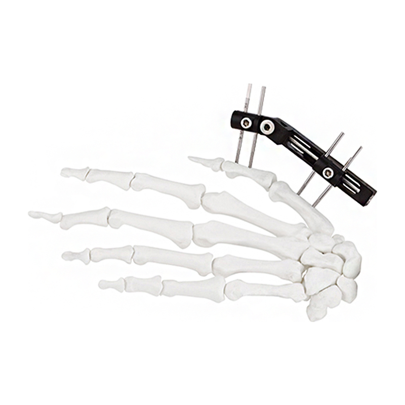 Cn Manufacturer Finger External Fixator for Mini Fixator Straight Type