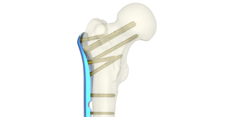 China Proximal Femur Locking Plate V Suppliers, Pricelist