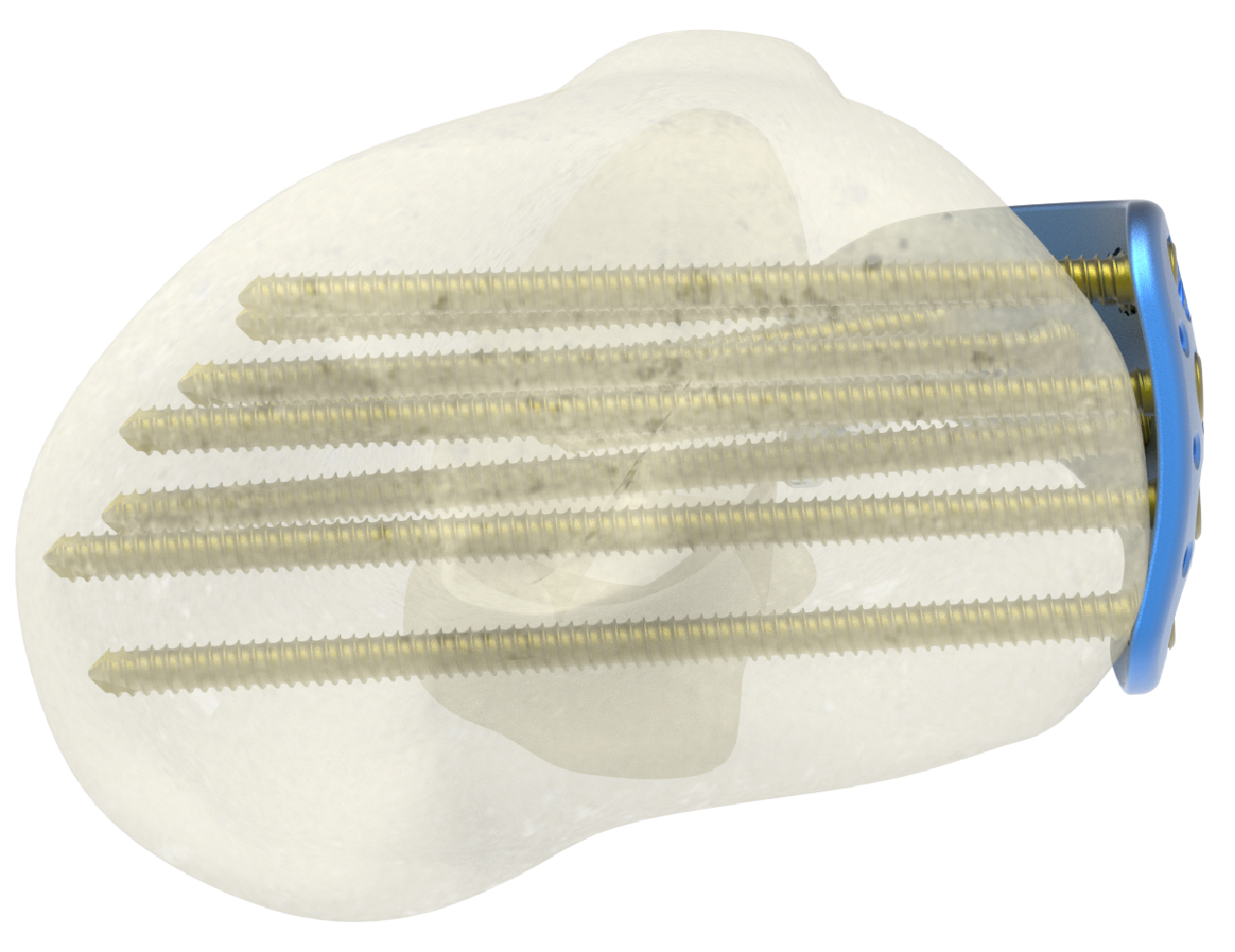 Proximal Lateral Tibia Rafting Screw Configuration