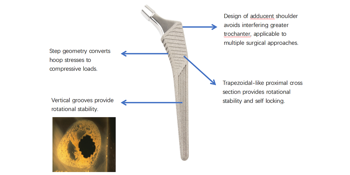 Hip Joint Replacement Overview