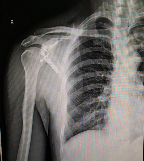 Scapula Locking Plate View 1