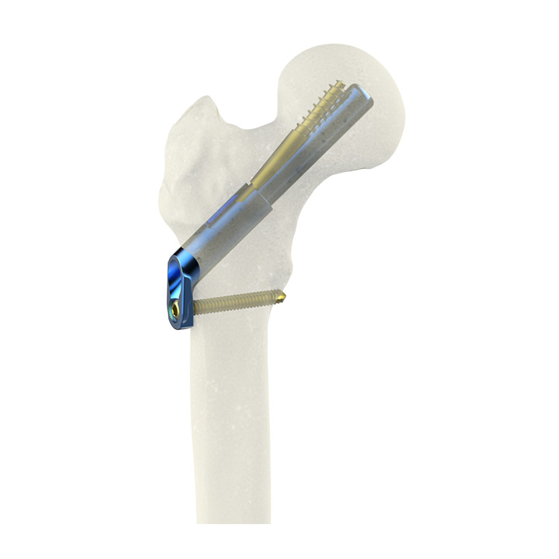 Custom Femoral Neck Antirotation System (FNAS) Exporters, Product