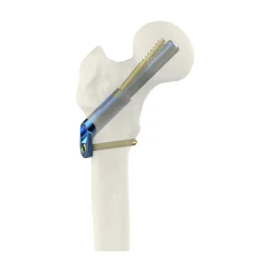 Custom Femoral Neck Antirotation System (FNAS)