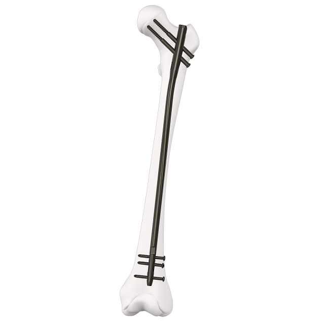 CE Certification Customized Expert Tibia Intramedullary Nail Implant  Pricelist, Products