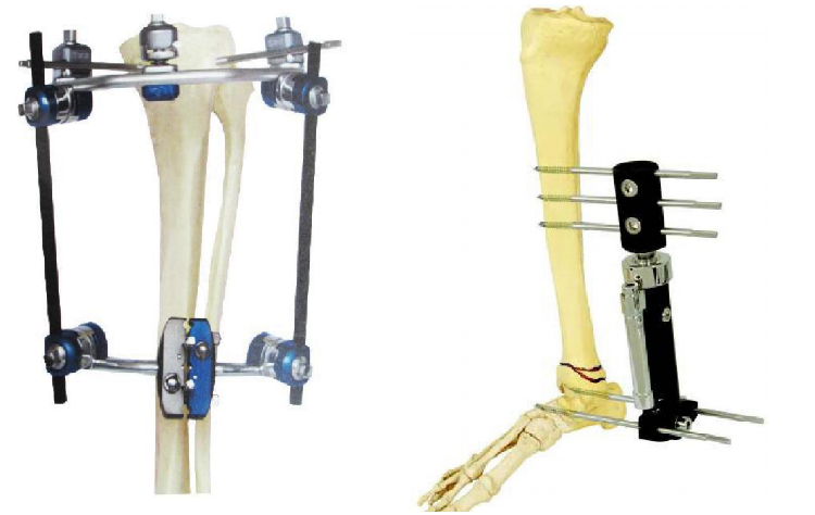 Externa Fixator