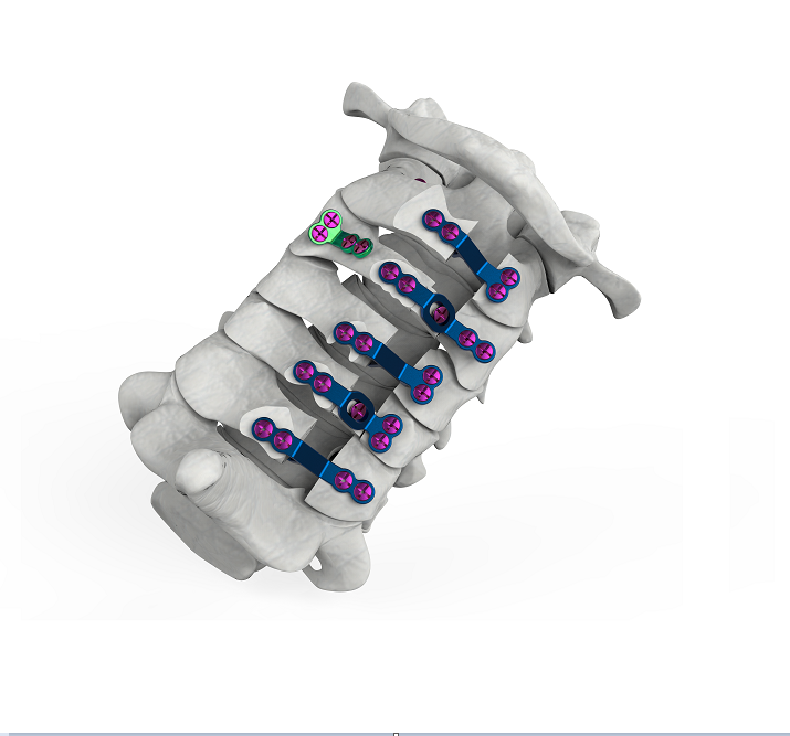 ODM Posterior Cervical Plate Fixation Dome Laminoplasty Plate Bone Implant Pricelist, Service