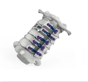 ODM Posterior Cervical Plate Fixation Dome Laminoplasty Plate Bone Implant Pricelist, Service
