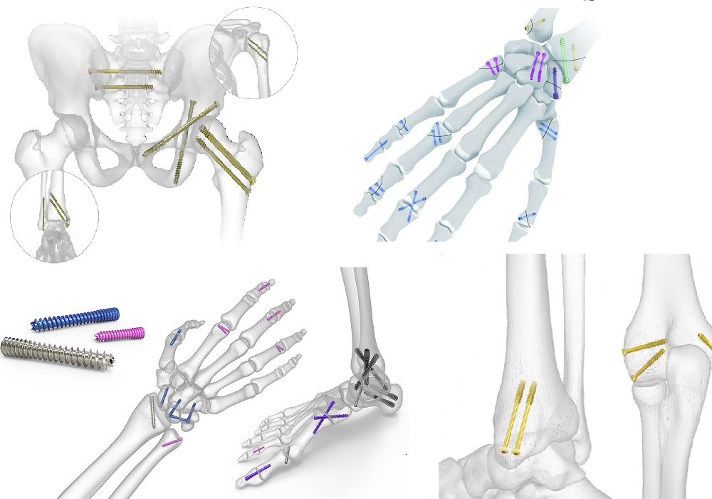 Cannulated Screw Dimensions