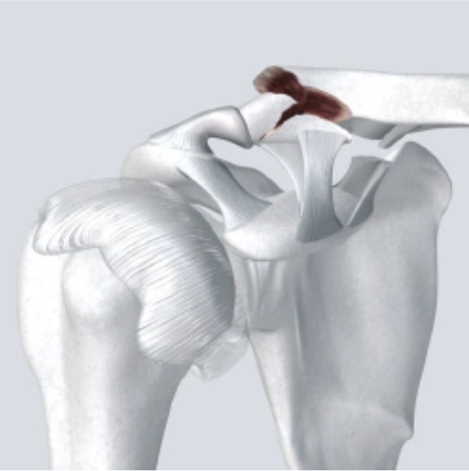 Clavicle Hook Locking Compression Plate Design