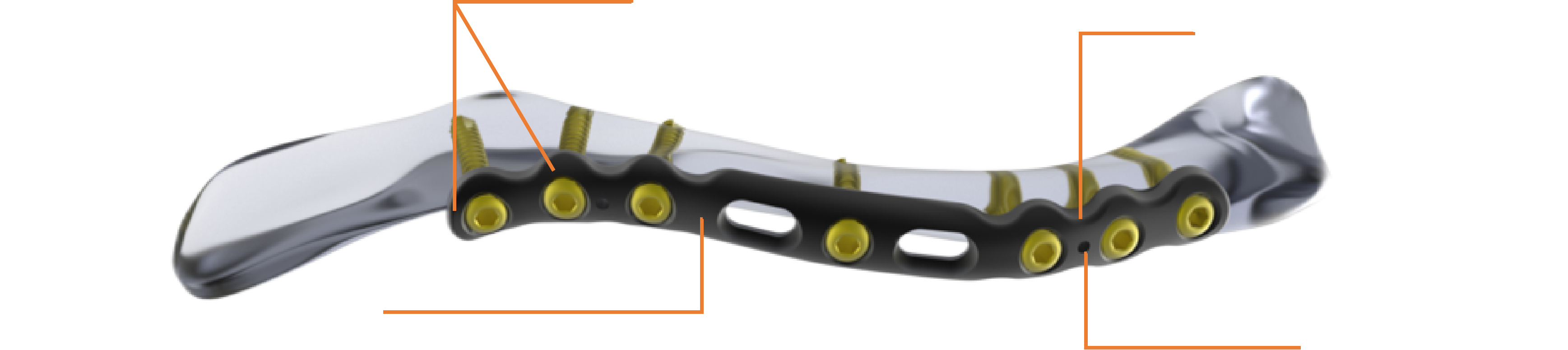 Clavicle Plate Detailed Structure and Contouring