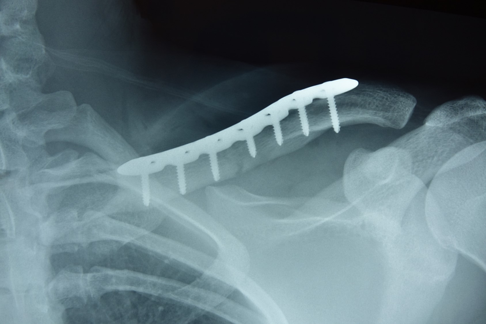 Wholesale Clavicle Reconstruction Locking Compression Plate Supplier, Exporters