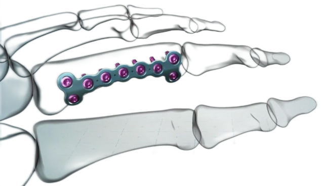 Metacarpal Neck Locking Plate