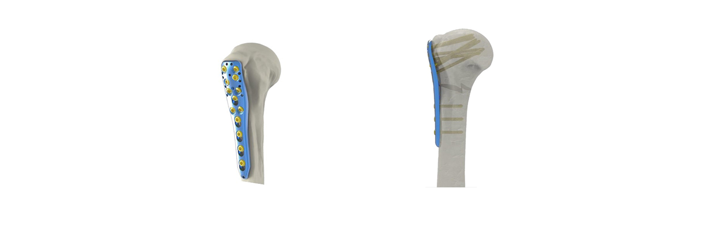 Optimal Screw Placement Diagram