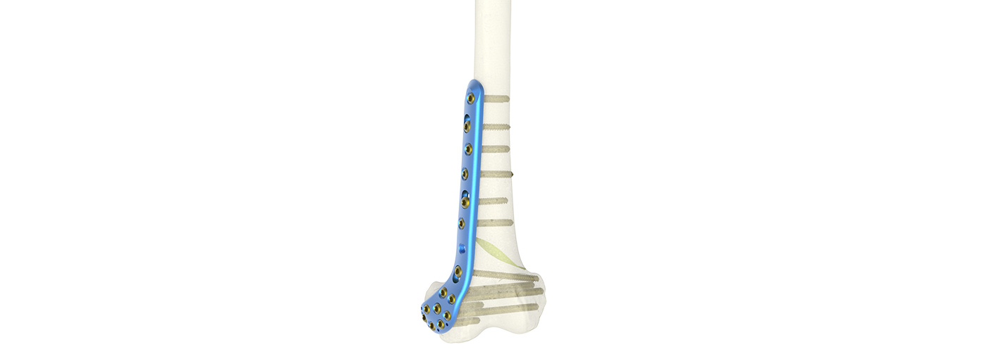 Discount Distal Medial Femur Locking Compression Plate Pricelist, Products