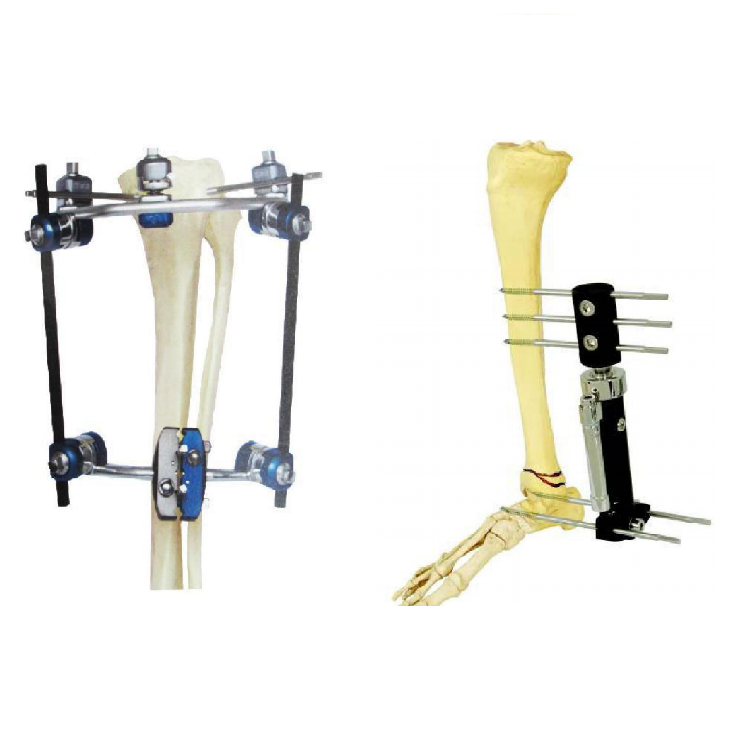 Discount Orthopedic stainless synthes external fixation fixator  Factories, Pricelist