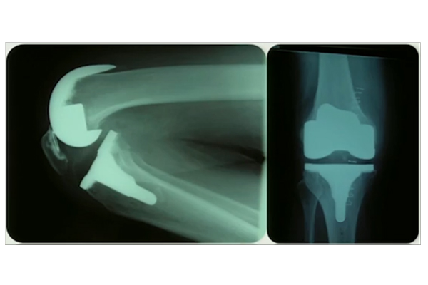 Traditional articular surface