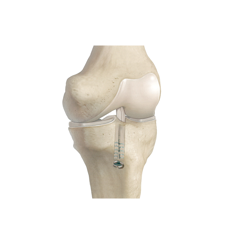 OEM Zath Sports Medicine Orthopedic Suture Anchor Implant Company, Service