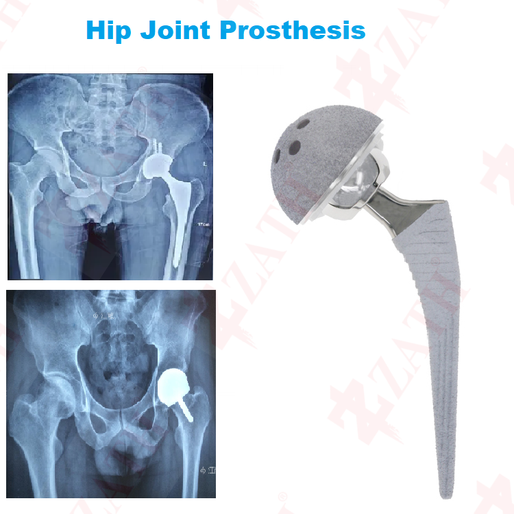 China CDC Ceramic Acetabular liner of hip joint prosthesis Suppliers, Companies