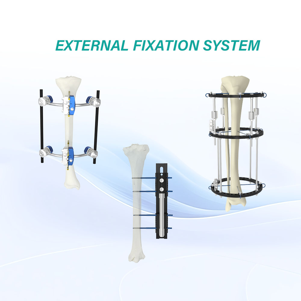 Discount Orthopedic stainless synthes external fixation fixator  Factories, Pricelist