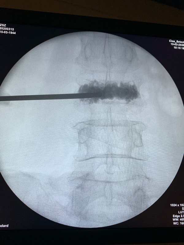 Vertebroplasty Development History