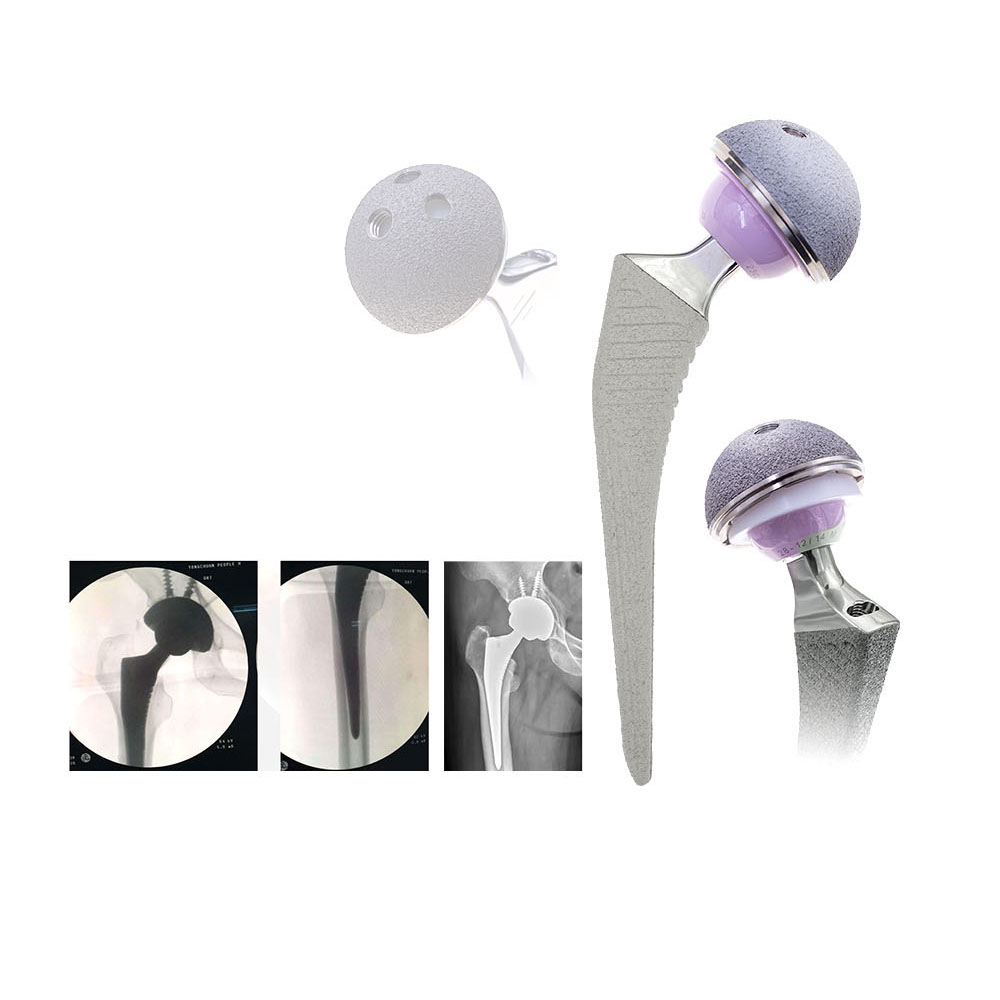 Discount Professional Medical Hip Implant Titanium Bipolar Hip Joint Prosthesis  Manufacturers, Supplier