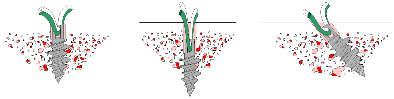 Orthopedic Anchor Insertion