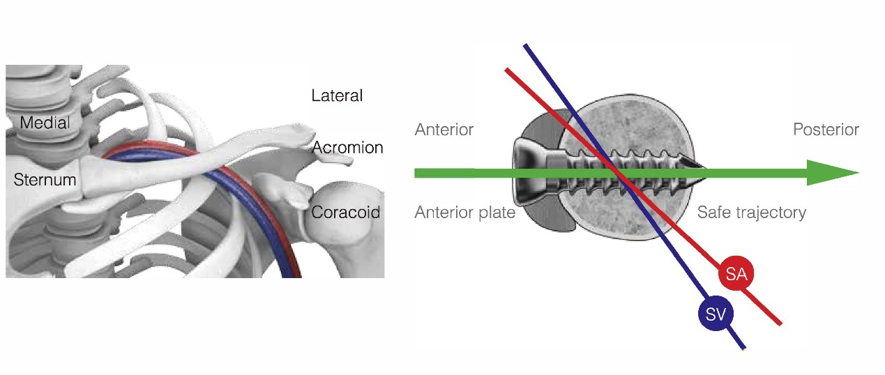 Anteromedial Clavicle Locking Compression Plate Anatomical Fixation
