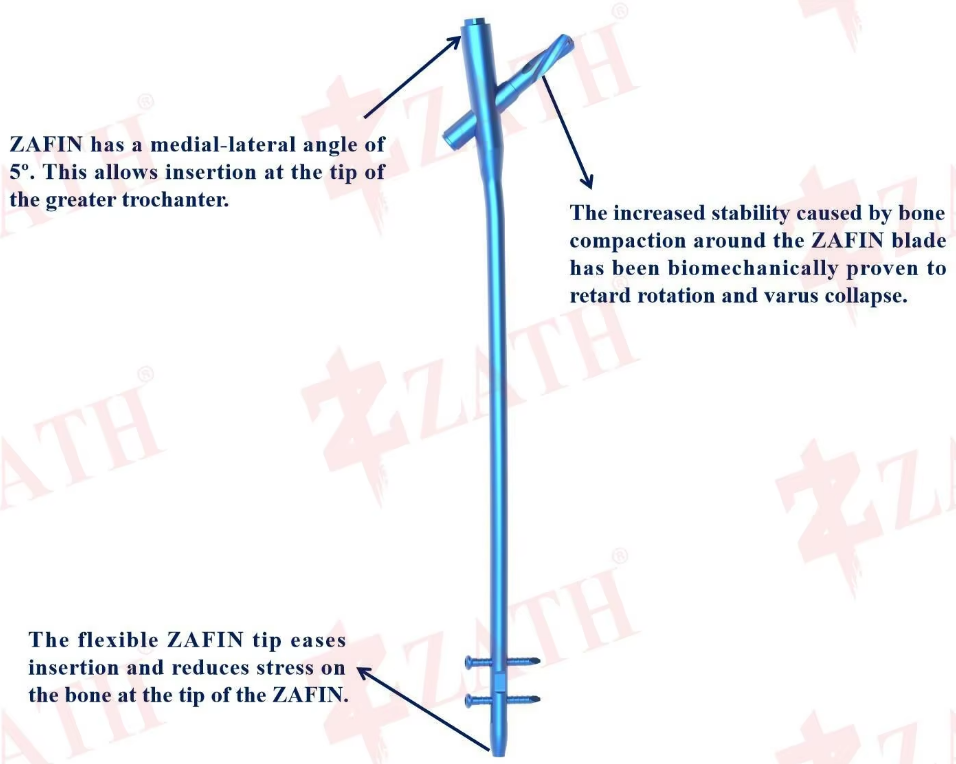 ZAFIN Proximal Femur Nail System Overview