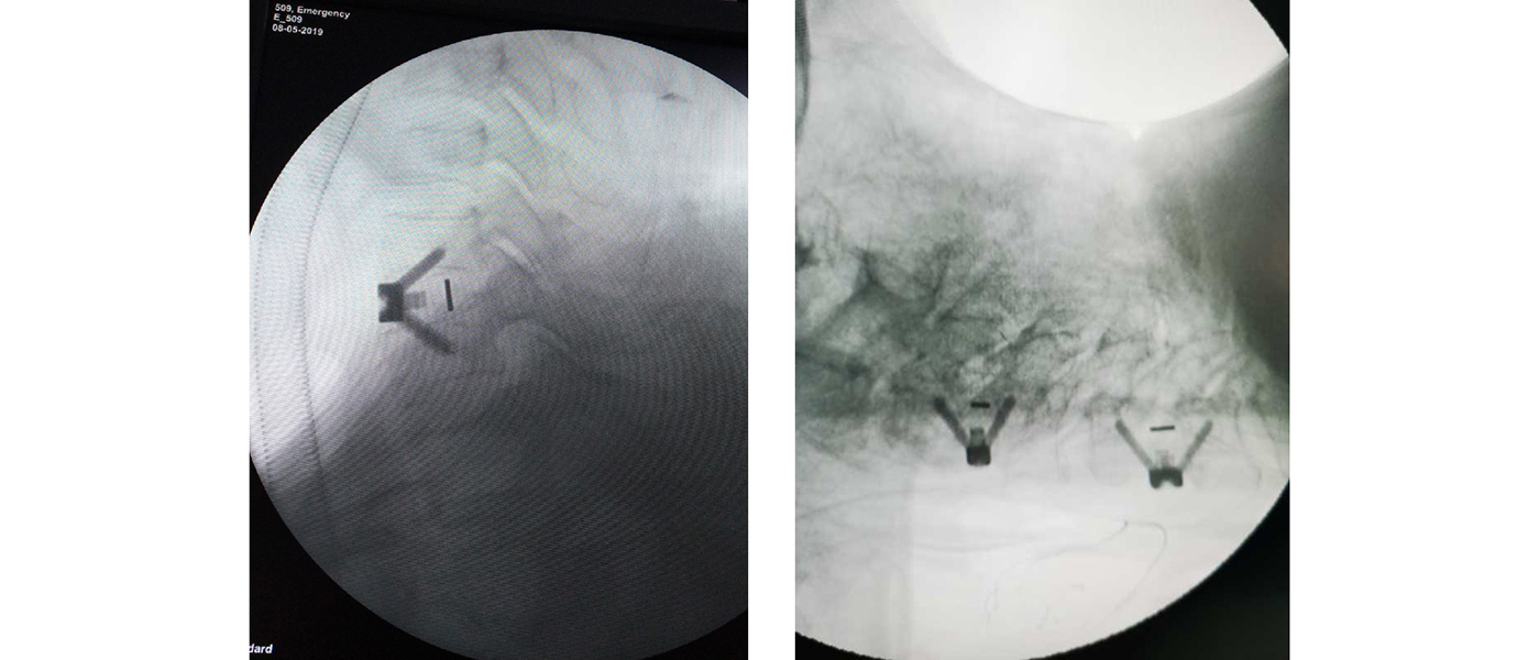 Spinal Pathologies Overview