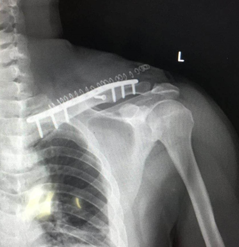 Clavicle Locking Compression Plate Application