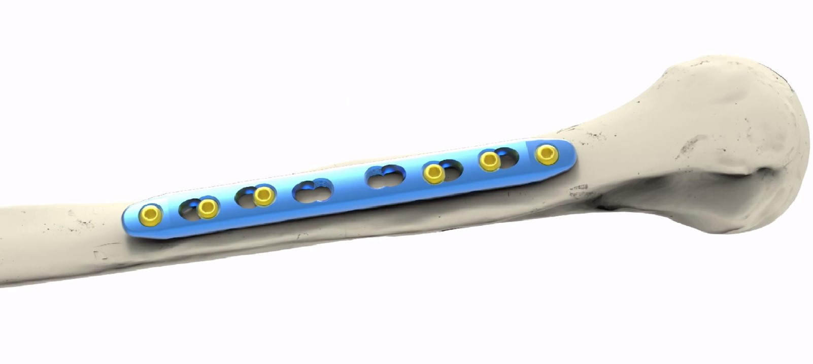 Humerus Limited Contact Locking Compression Plate fixation visual