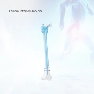 Cheap Surgical Orthopedic Implant Titanium ZAFIN Intramedullary Nail Pricelist, Exporters