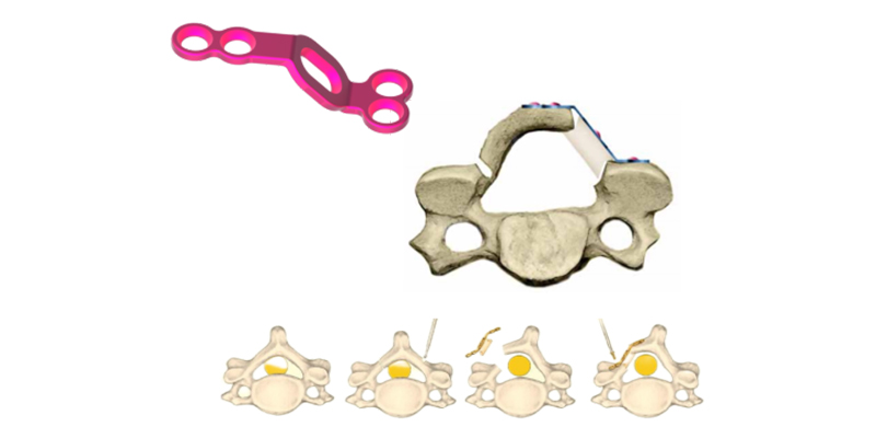 Dome Graft Plate