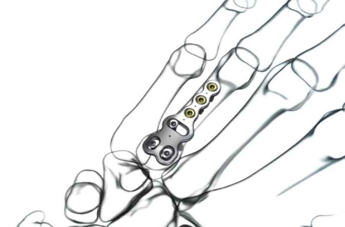 Hand Fracture Locking Plate System
