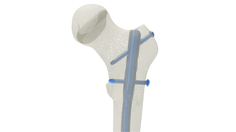 Femoral Nail Feature 1