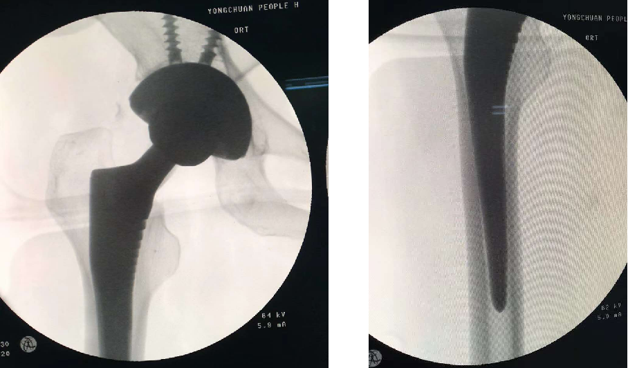 Hip Joint Arthroplasty Implant