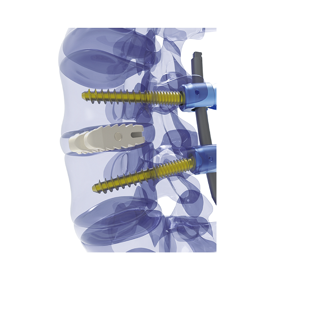 Famous Thoracolumbar Interbody Cage (Straight) Manufacturers, Factories