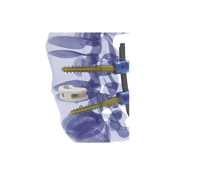 ODM Thoracolumbar Interbody Cage (Angled) Exporter, Company