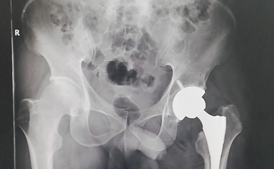 Hip Joint Replacement Implant Configuration