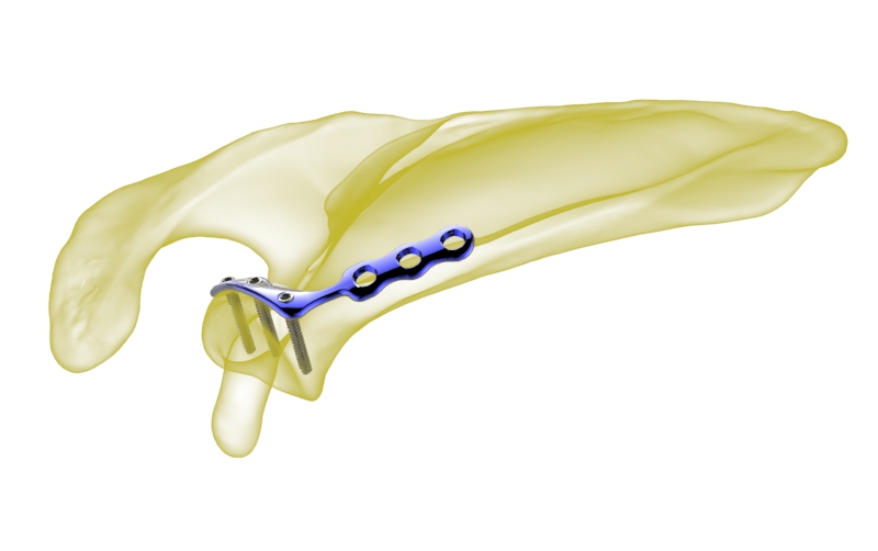 Scapula Locking Plate View 2