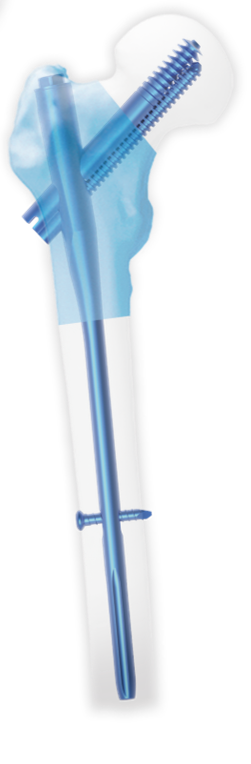 Femoral Nail Diagram