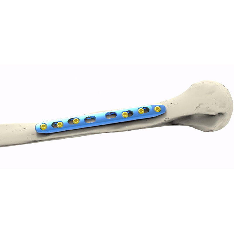 China Humerus Limited Contact Locking Compression Plate Manufacturer, Service