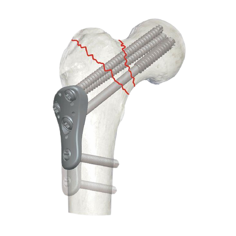 High-Quality Proximal Femur MIS Locking Plate II Suppliers, Product