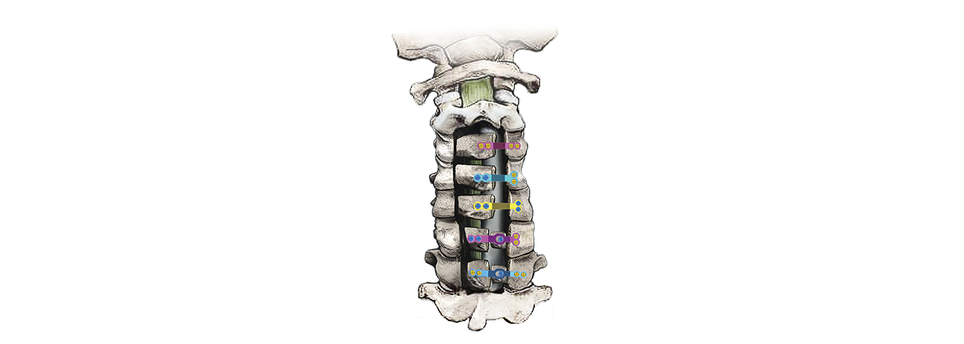 Plate Fixation View