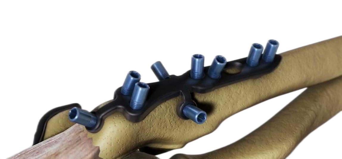 China Proximal Ulna ISC Locking Compression Plate I Pricelist, Service
